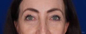 After Image: Blepharoplasty & Endoscopic Temporal Browlift