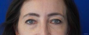 Before Image: Blepharoplasty & Endoscopic Temporal Browlift