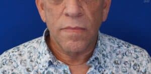 After Image: Deep Plane Face & Neck Lift