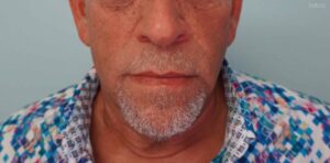 Before Image: Deep Plane Face & Neck Lift