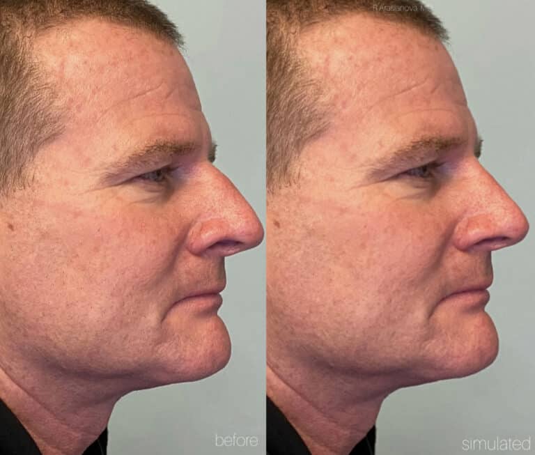 Before Image: Primary Surgical Rhinoplasty - right-side