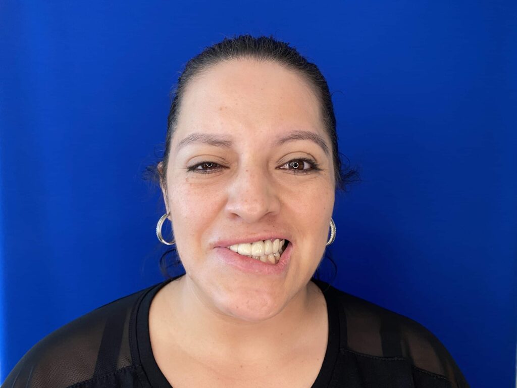 1761832646_right-synkinesis-1-1-scaled