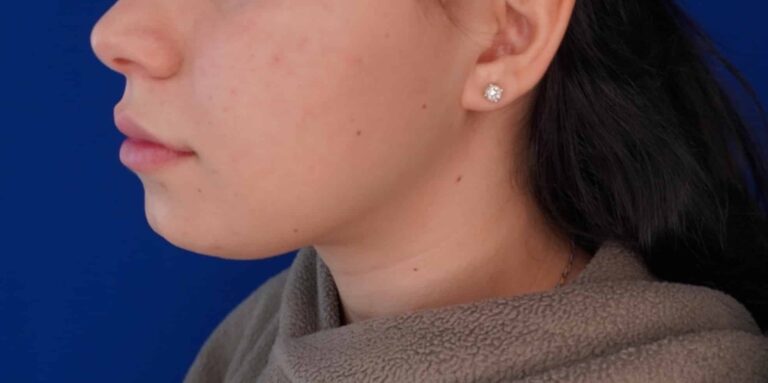 Before Image: Submental Liposuction - left-front-oblique