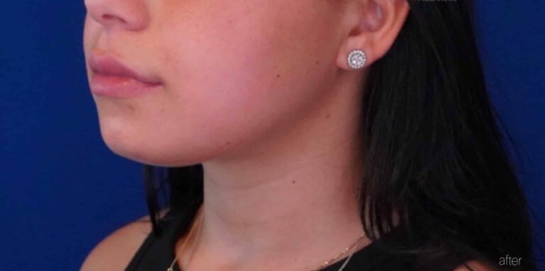 After Image: Submental Liposuction - left-front-oblique