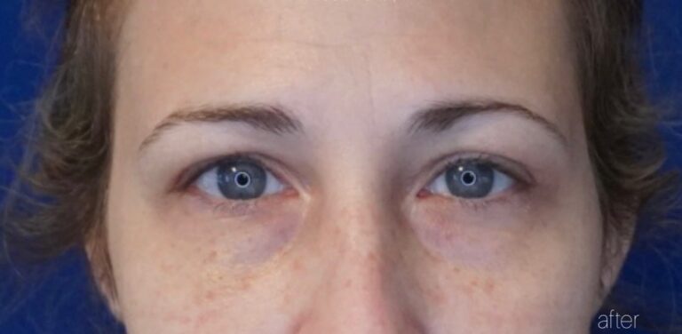 After Image: Brow Lift Ptosis - front