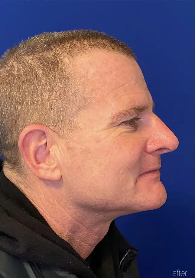 After Image: Primary Surgical Rhinoplasty - right-side