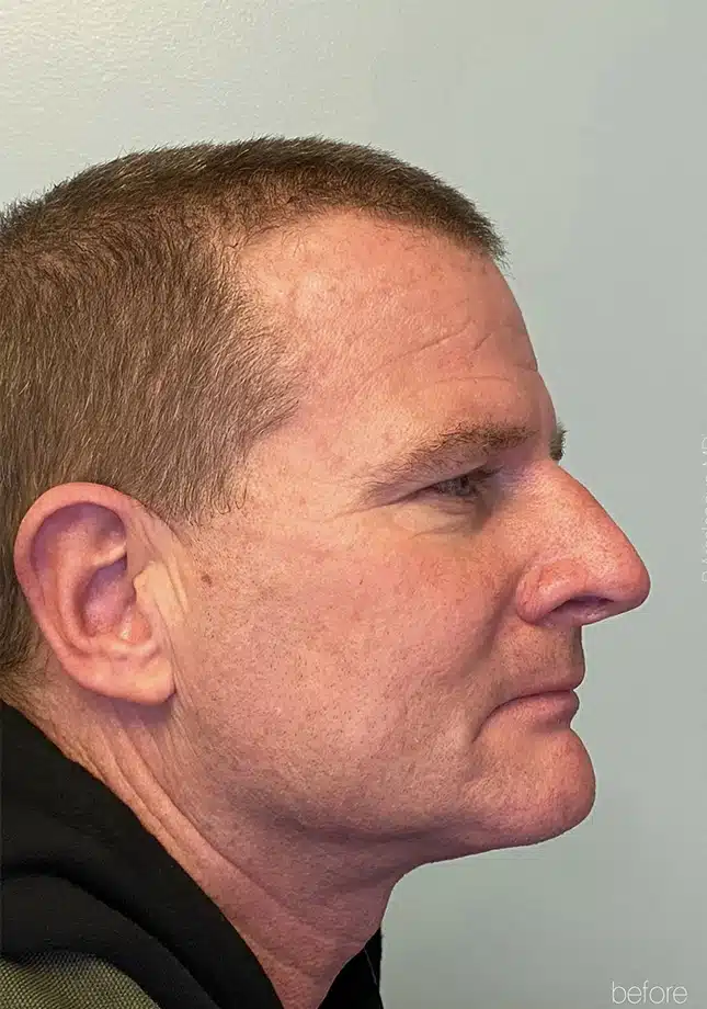 Before Image: Primary Surgical Rhinoplasty - right-side