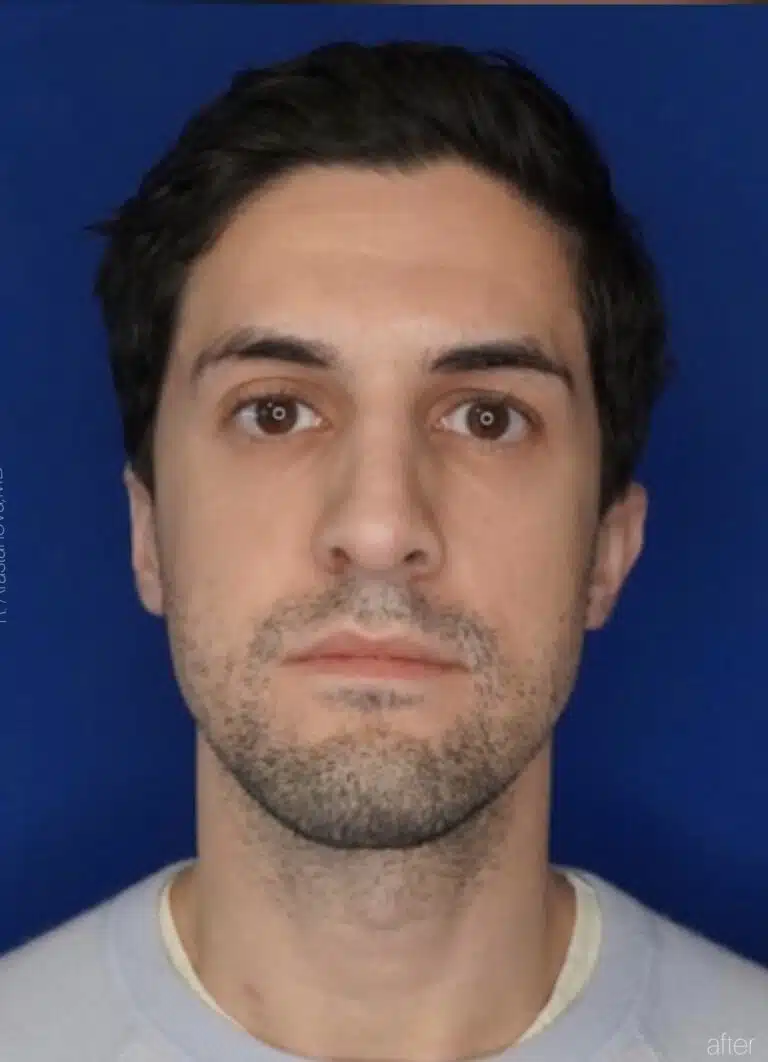 After Image: Primary Surgical Rhinoplasty - front