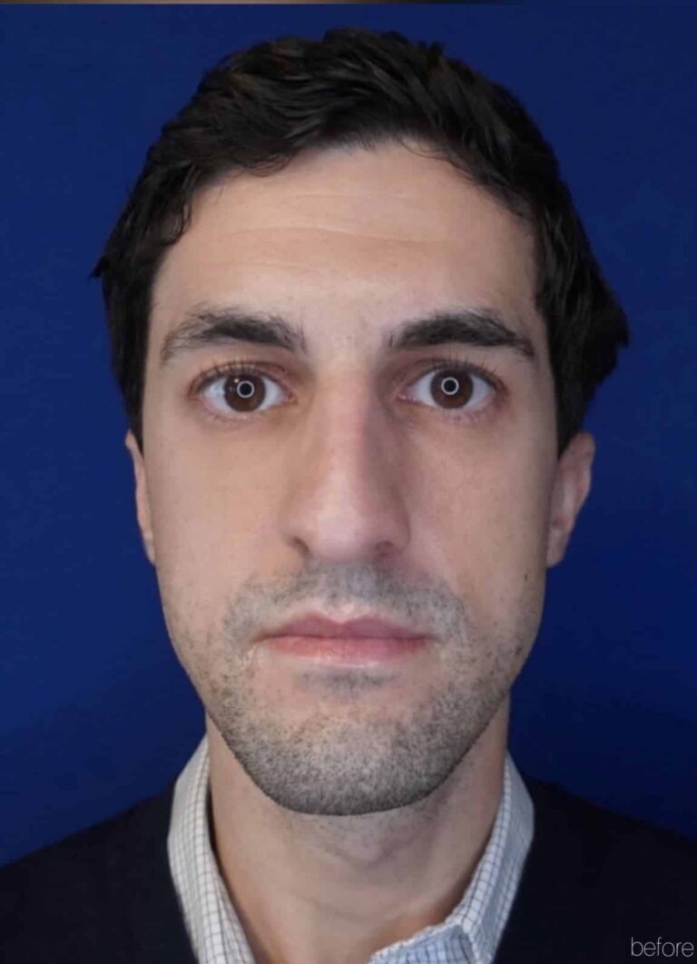 Before Image: Primary Surgical Rhinoplasty - front